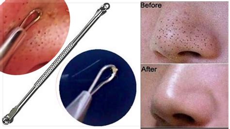 Knowing When to Consult a Professional for Blackhead Removal