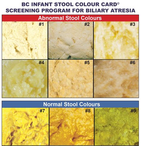 Malabsorption Issues: Role in Formation of Pale Colored Stools