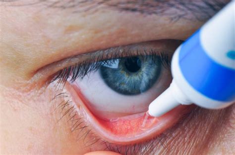 Medical Approaches to Addressing Conjunctivitis: Prescription and Over-The-Counter Solutions