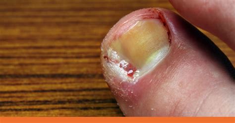 Physical Causes: Nail Injuries and Infections