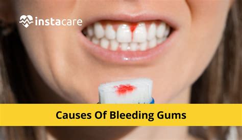 Physical Health Conditions Associated with Gum Bleeding in Dreams