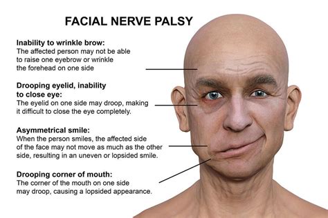 Physical Implications: Reflecting Health Issues in Facial Paralysis During Dreams