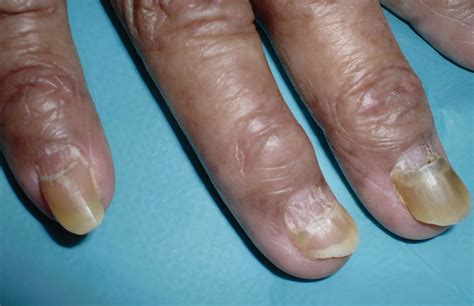 Possible Interpretations: Exploring Different Significances behind Shedding of Fingernails