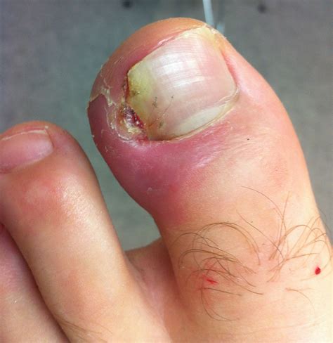 Possible Physical Factors Leading to the Decay of Toenails