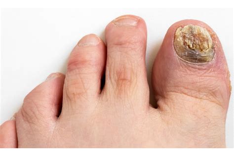 Potential Approaches for Managing Fungal Afflictions of the Toenails in Reality