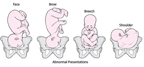 Potential Concerns with Babies in an Abnormal Position