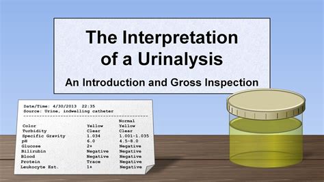 Potential Implications of White Urine: A Deeper Analysis