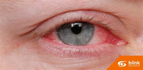 Preventing Pink Eye: Effective Hygiene Practices and Eye Safety Tips