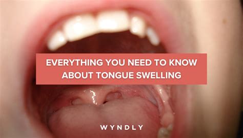 Preventing Tongue Swelling: Tips and Recommendations