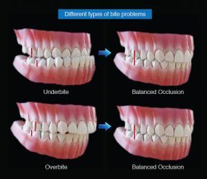 Preventing and Correcting Changes in the Position of Anterior Teeth: Dental Solutions