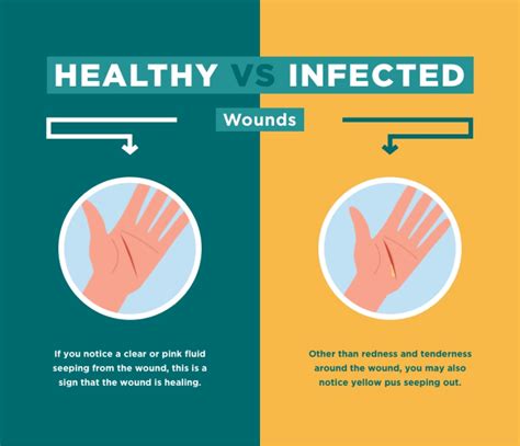 Recognizing the Early Signs of Hand Infection
