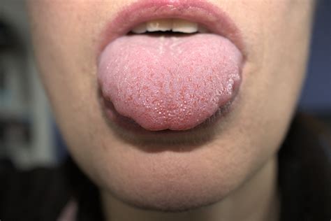 Recognizing the Indications of Tongue Enlargement