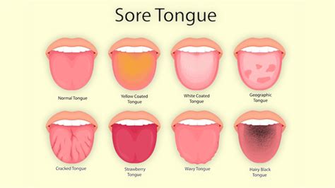 Recognizing the Symptoms: Understanding the Significance of Tongue Enlargement in Dreams