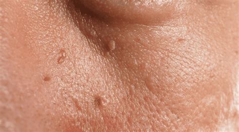 Skin Tags and Insecurities: Understanding the Psychological Impact