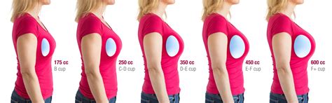 The Advantages of Breast Implants: Enhancing Your Desired Silhouette