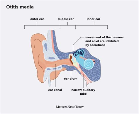 The Common Causes of Otitis