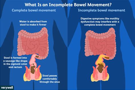 The Connection Between Bowel Movement Nightmares and Unresolved Matters