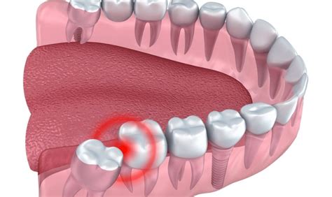 The Connection Between Stress and Dental Misalignment in Dreamscapes