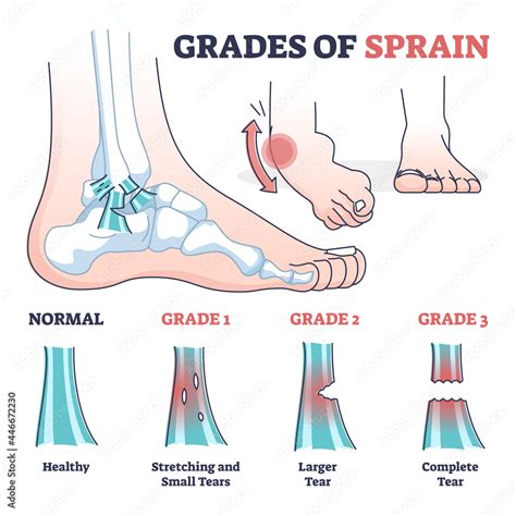 The Cultural and Historical Importance of Ankle Injuries in the Analysis of Dreams