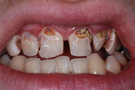 The Frightening Reality: The Troubling Experience of Cavities