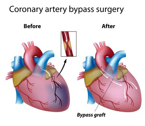 The Incredible Potential of Cardiac Surgery