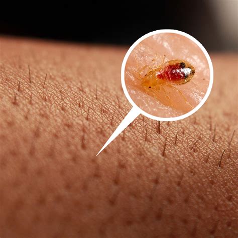 The Intriguing Phenomenon of Tiny Insects Scuttling Beneath the Skin