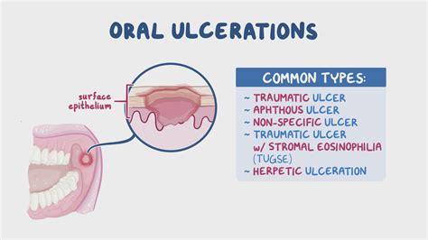 The Main Culprits Behind Oral Ulcers