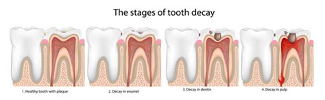 The Origins behind Decayed Dentition