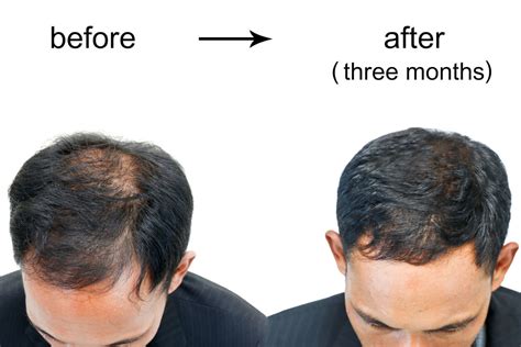 The Path to Hair Regrowth: Exploring Effective Treatments for Thinning Areas