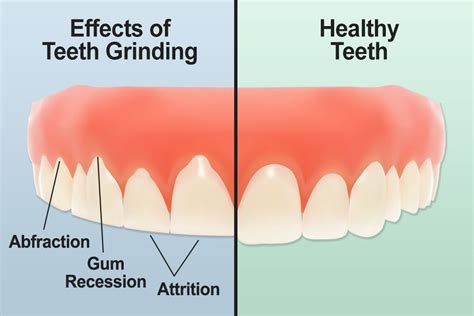 The Physical Causes of Tooth Grinding