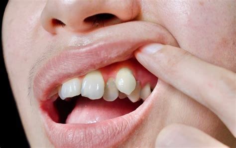 The Possible Causes for the Misalignment of your Teeth in Your Dream State