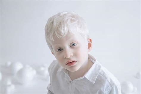 The Profound Spiritual Significance of Dreaming about a Person with Albinism