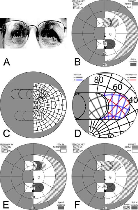 The Relationship Between Fractured Spectacles and Clarity