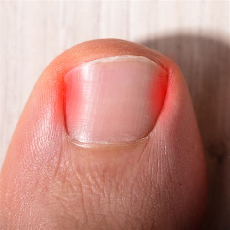 The Role of Proper Nutrition in Maintaining Optimal Toenail Health