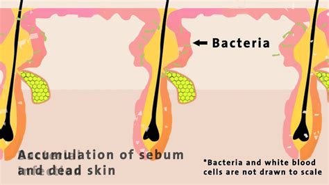 The Science of Acne: Exploring the Biological Mechanisms Behind Blemishes