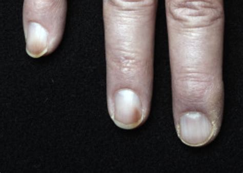 The Scientific Explanation behind Nail Discoloration