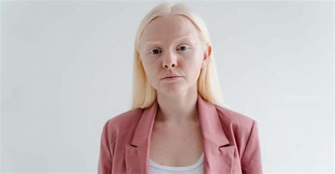 The Significance of an Albino Child's Dream