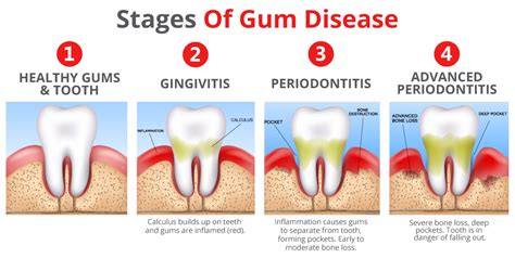 Tips to Manage Gum Infection and Enhance the Quality of Your Dreams