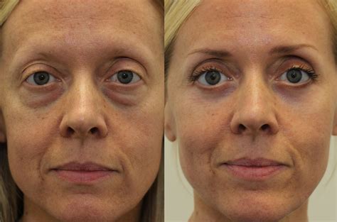 Transform Your Appearance Naturally: Simple Changes for Under-Eye Bags Reduction