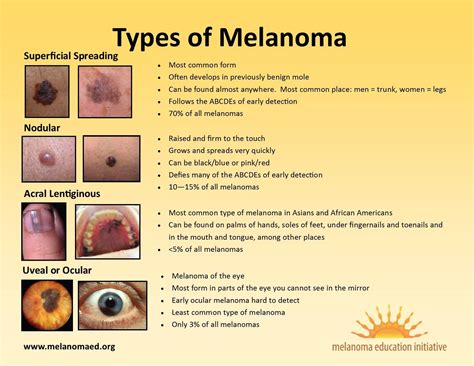 Types of Cutaneous Melanoma and Their Characteristics