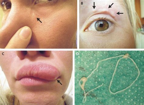 Unbelievable Discovery: Larvae Found Inside a Woman's Facial Region