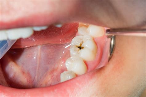 Unconscious Messages: Deciphering the Hidden Meanings of Dental Cavities