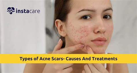 Understanding Acne Scars: Types, Causes, and Effects