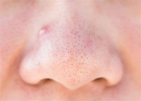 Understanding Blackheads: Causes and Types