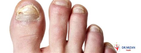 Understanding Onychomycosis: Causes, Symptoms, and Treatment