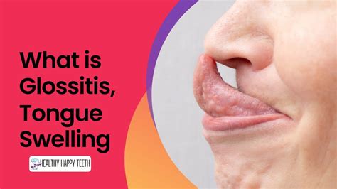 Understanding Tongue Edema: A Common Condition