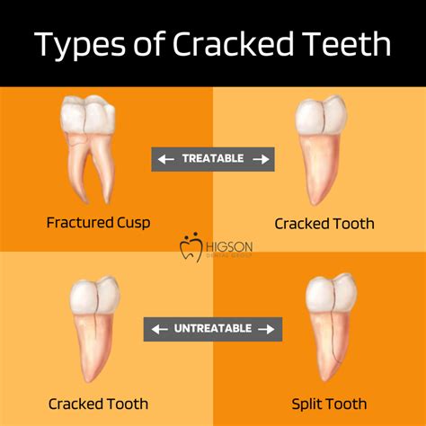 Understanding Tooth Cracks: Types and Symptoms