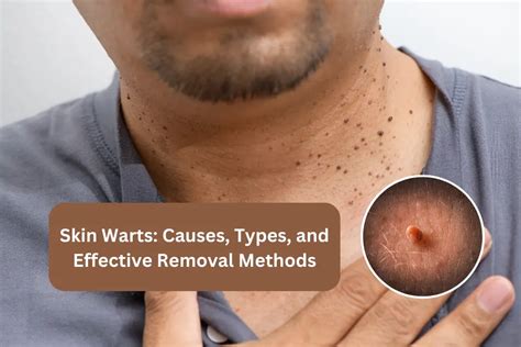 Understanding Warts: Causes and Origins