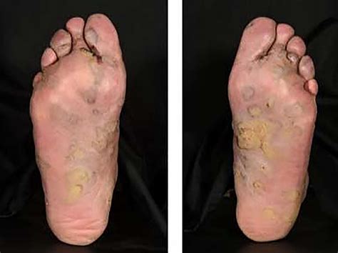 Understanding the Causes: Exploring the Origins of Foot Lesions