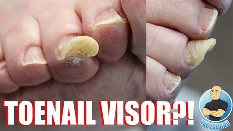 Understanding the Causes of Excessive Toenail Growth